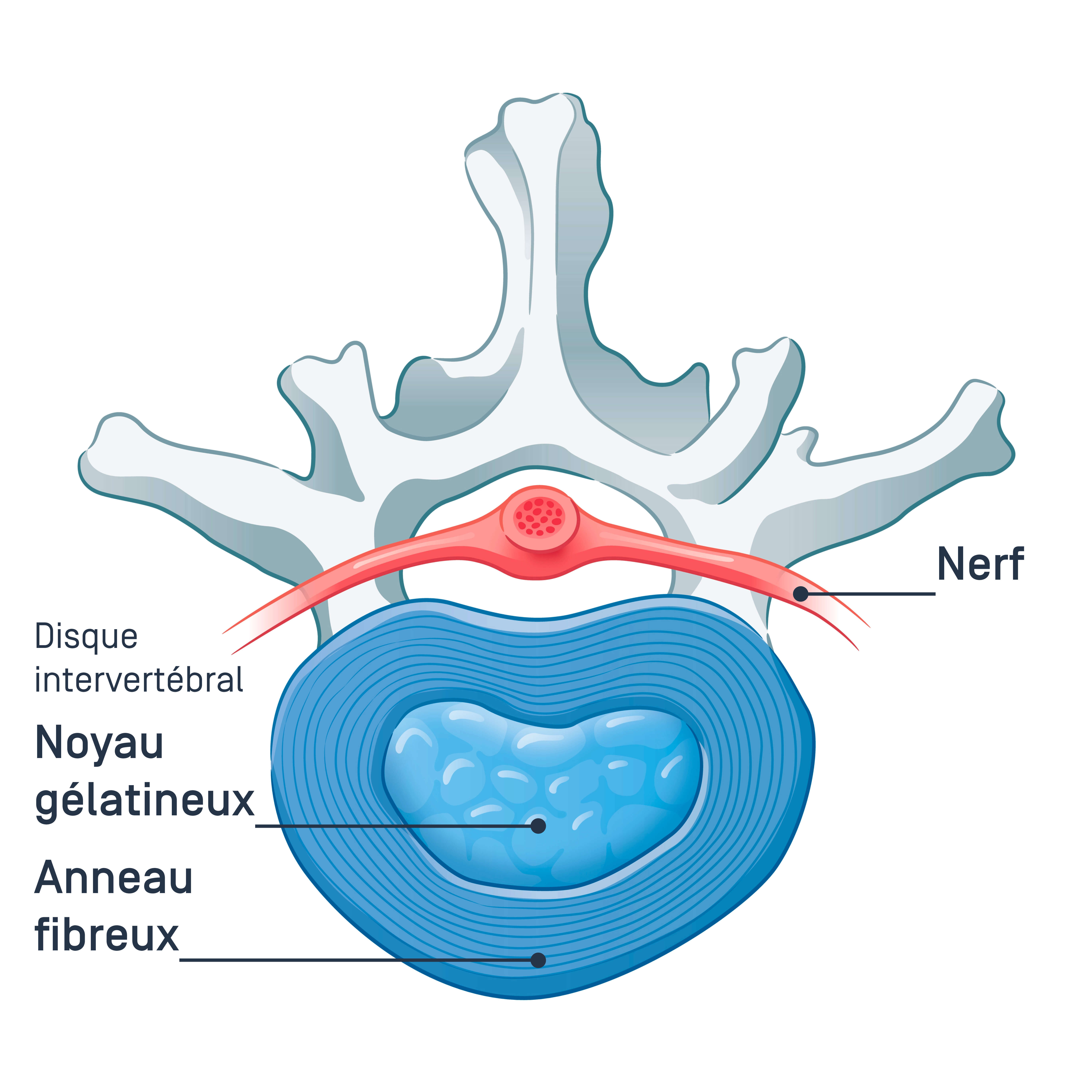 DisqueInterverébral