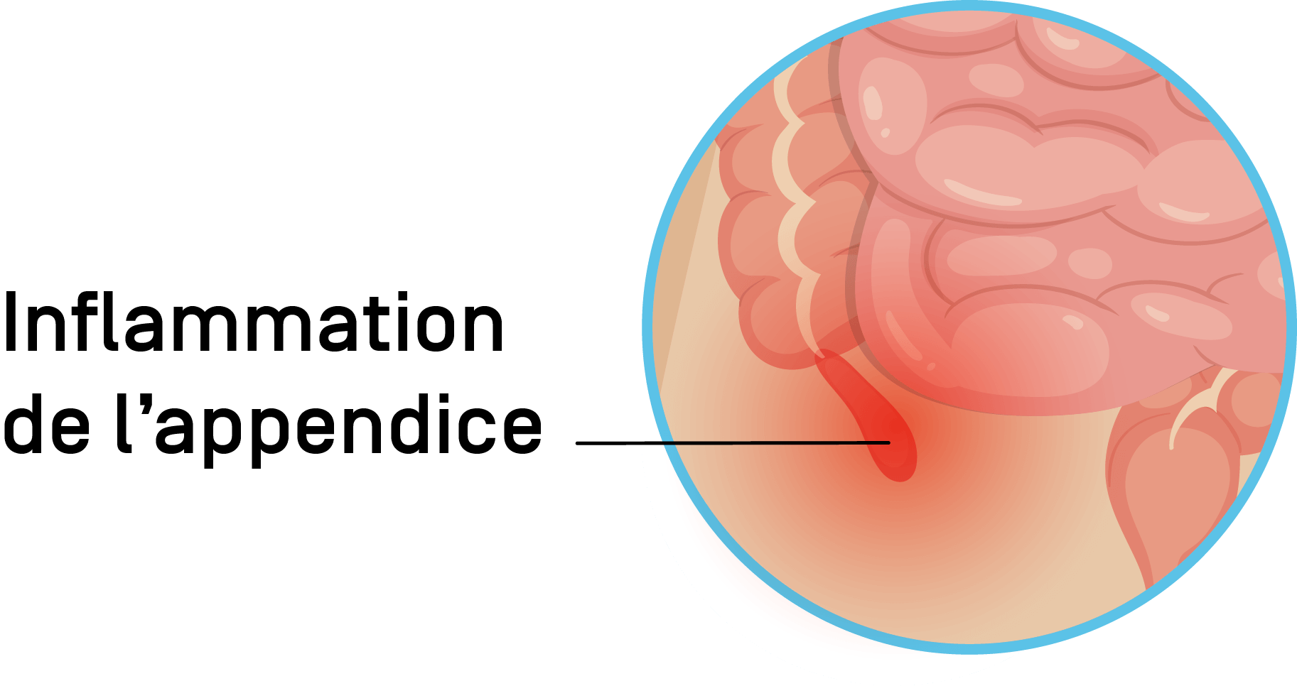 inflammation appendice