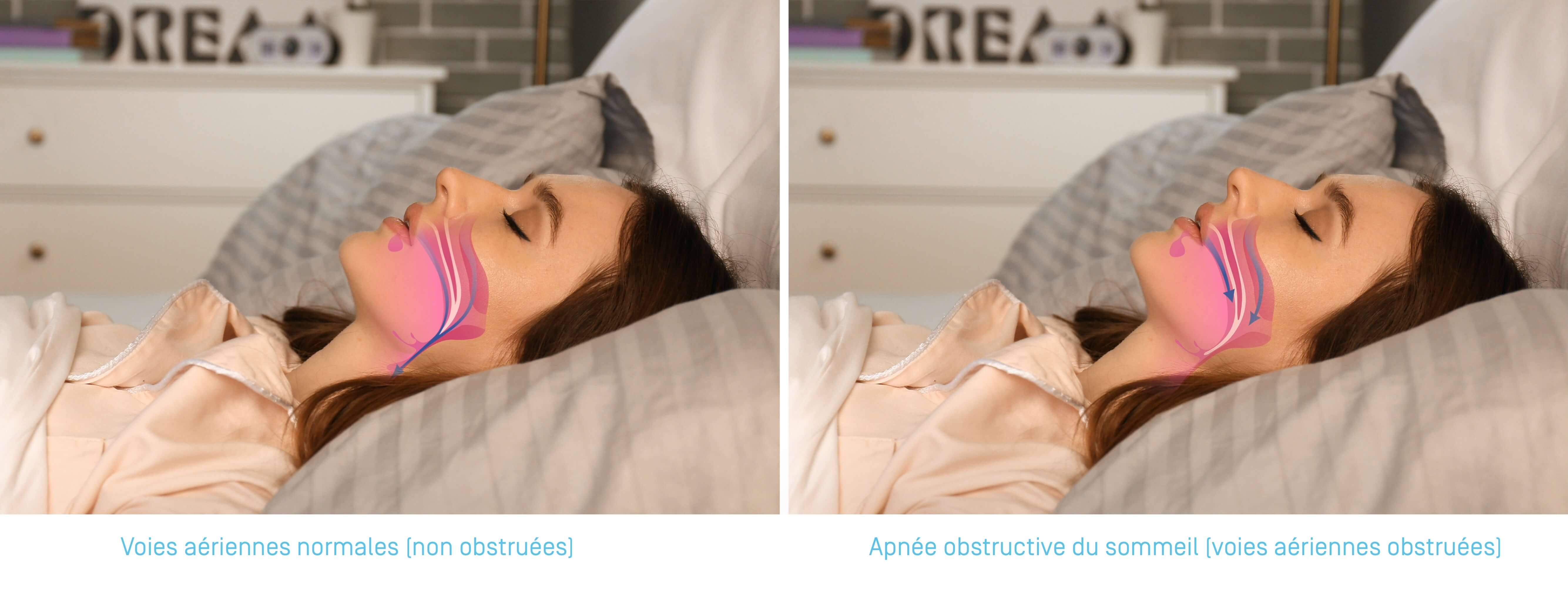 apnées obstructives du sommeil